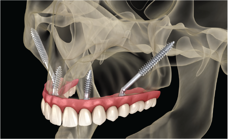 Zygomatic implants