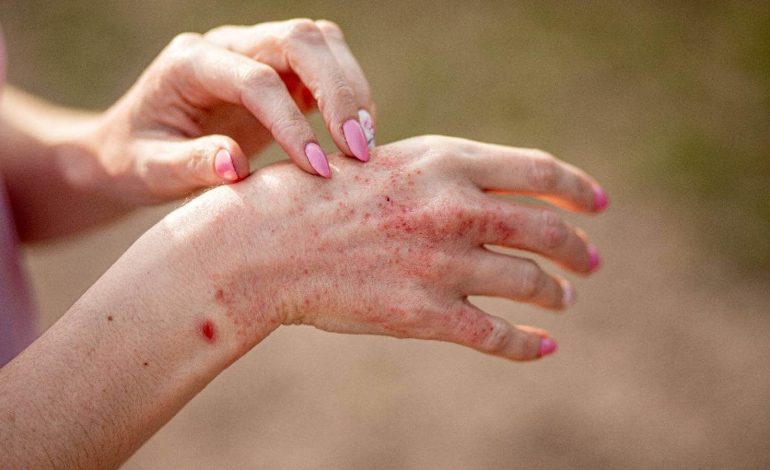 New Treatment for Moderate to Severe Atopic Dermatitis Shows Promising Long-Term Results