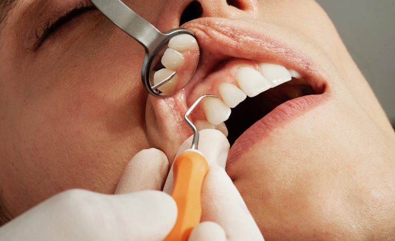 Obesity Raises The Risk Of Gum Disease By Inflating Growth Of Bone-Destroying Cells