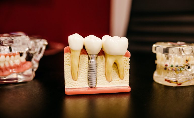 The Advantages of Dental Implants Over Dental Bridges