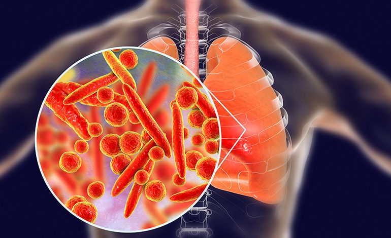 Pneumonia Treatment and Recovery