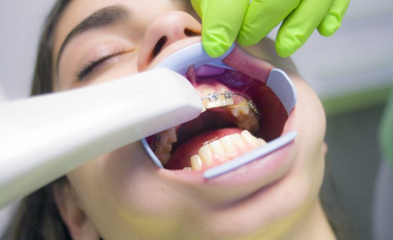 Everything to Know About Dental Bonding