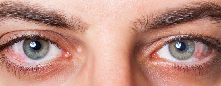 Anterior uveitis – Diagnosis and treatment