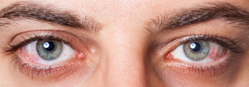 Anterior uveitis – Diagnosis and treatment