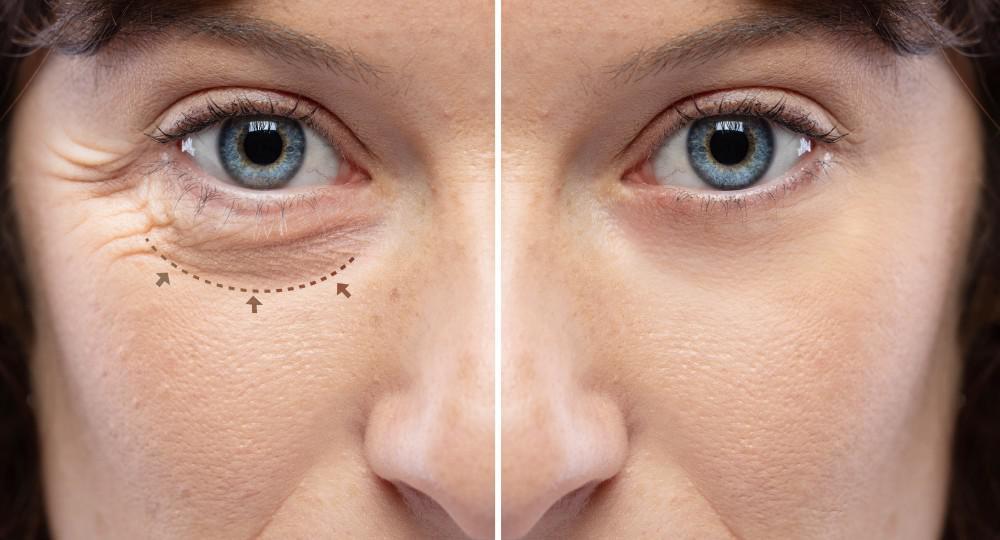 What is the difference between plastic surgery and oculoplastic surgery?