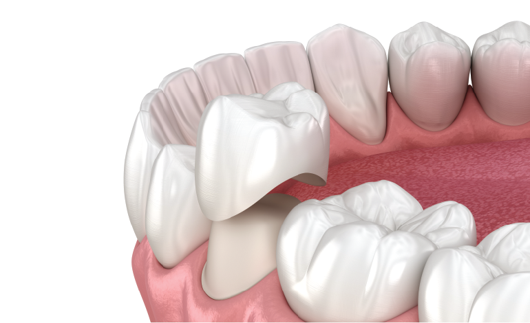 Dental crowns and other extra-coronal restorations