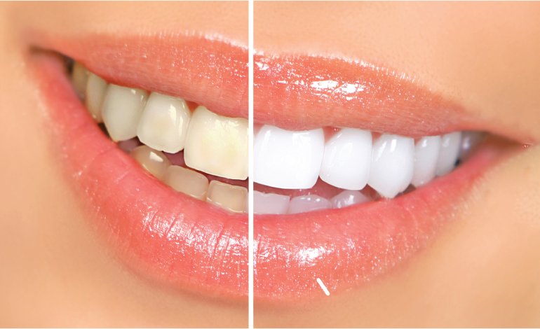 Can I Have Teeth Whitening If I Have Dental Implants or Crowns?