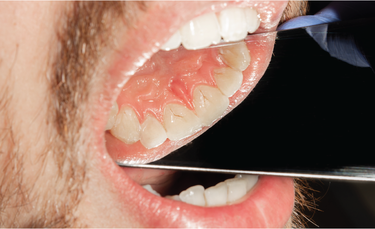 Creating Invisible Anterior Composite Restorations
