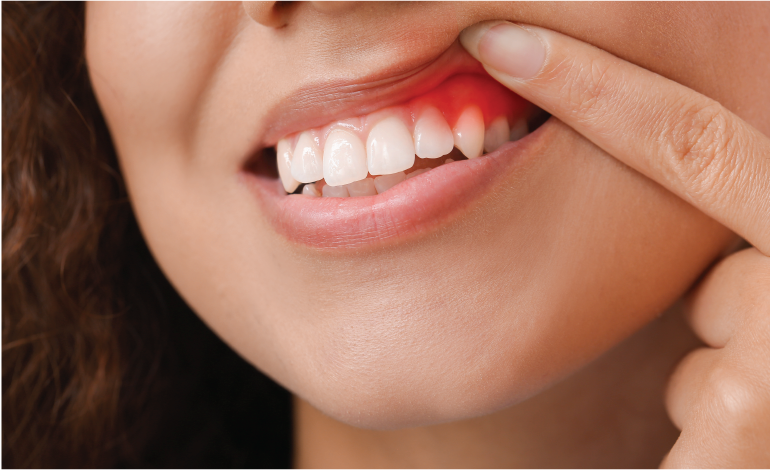 Vaping’s role in gum disease