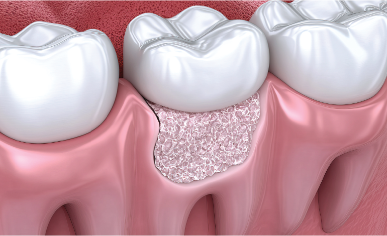 Receding gums and its treatment