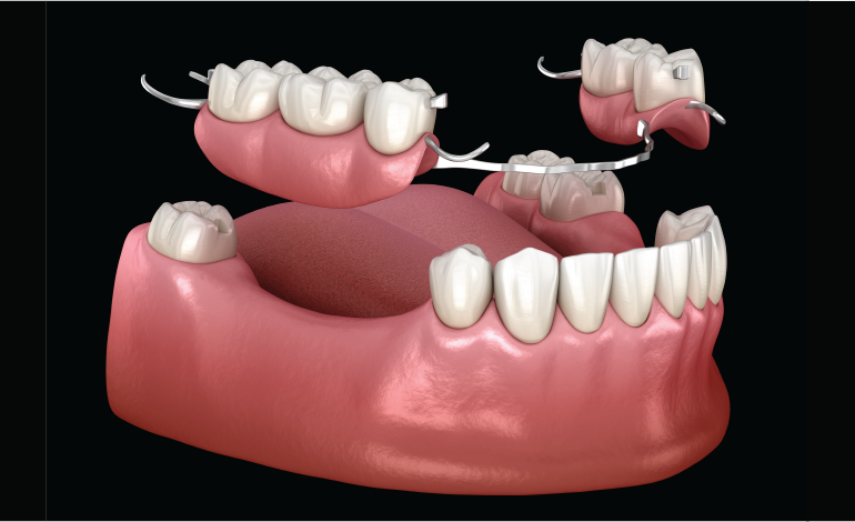Prosthodontic Treatment of The Severely Worn Dentition
