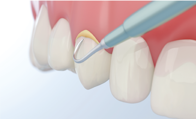 Nanozyme therapy prevents harmful dental plaque buildup