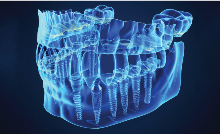 The Hidden Complication of Full-Arch Implant Prostheses