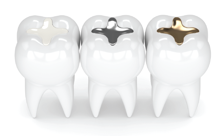 Different Types of Dental Fillings