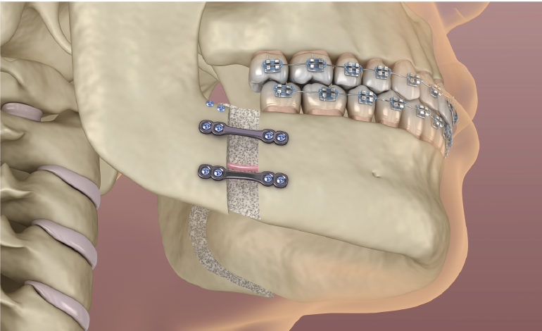Does facial asymmetry need corrective jaw surgery?