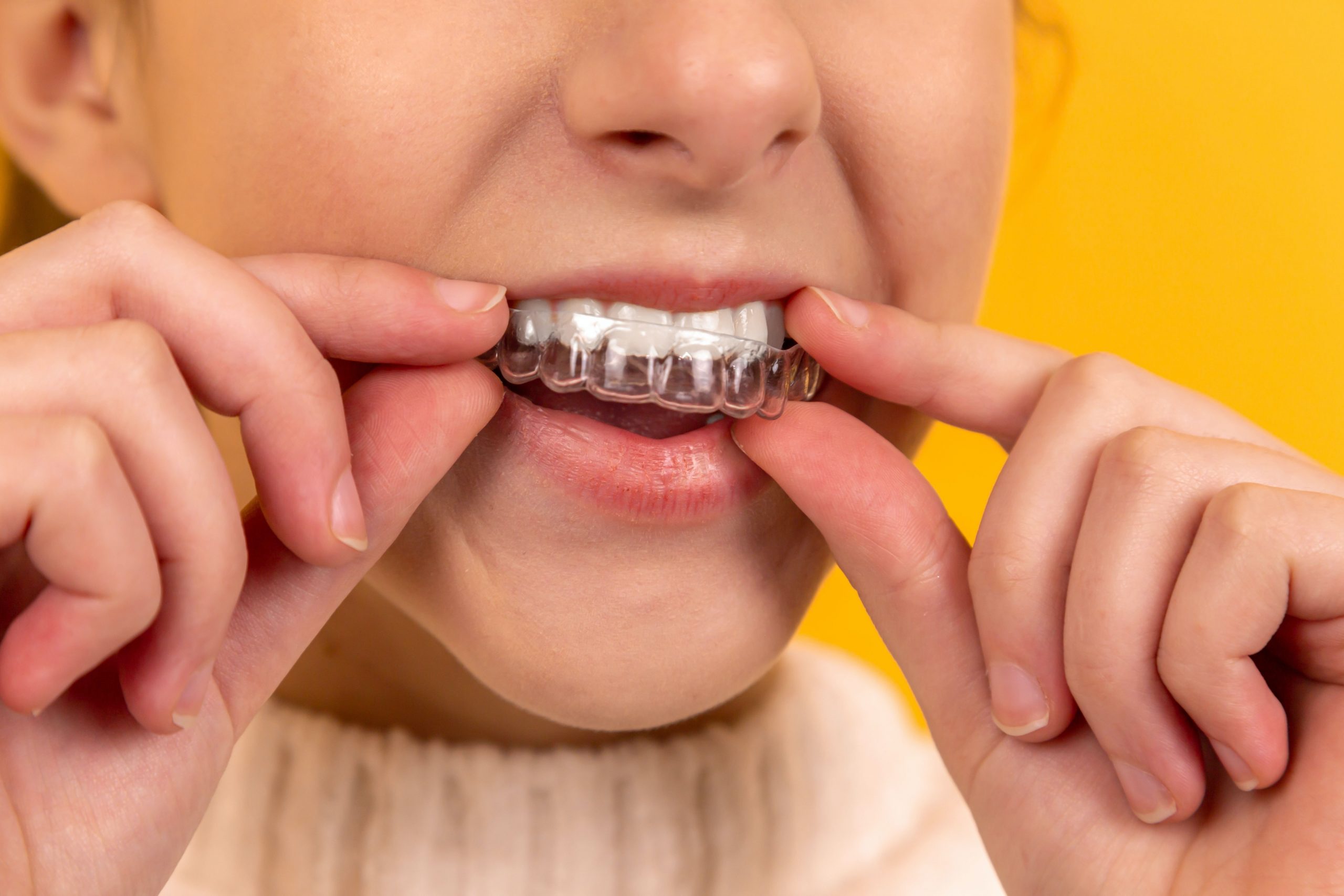 When do you waste unused aligner?