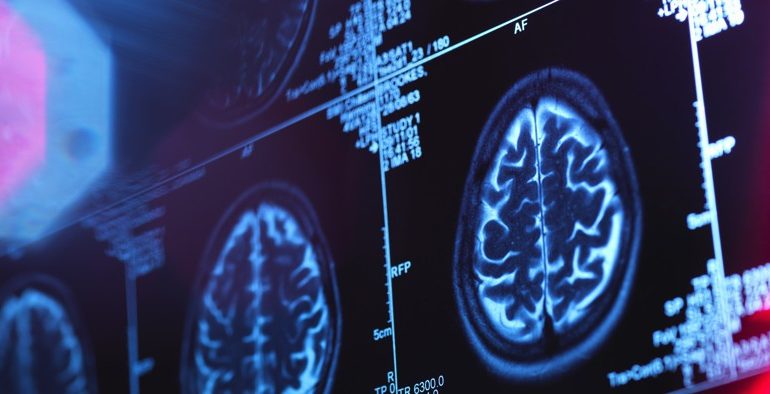 Even Mild Cases of COVID Might Change Your Brain