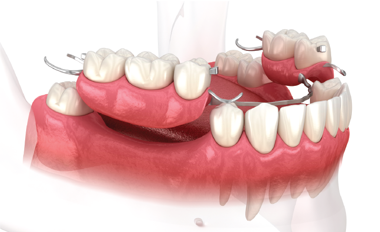 Everything You Need to Know About Partial Denture