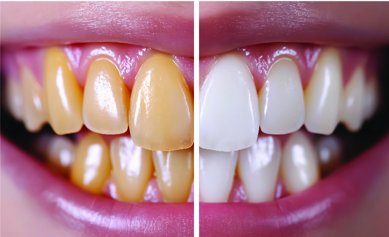 Non-Vital Teeth Discoloration and Internal Bleaching