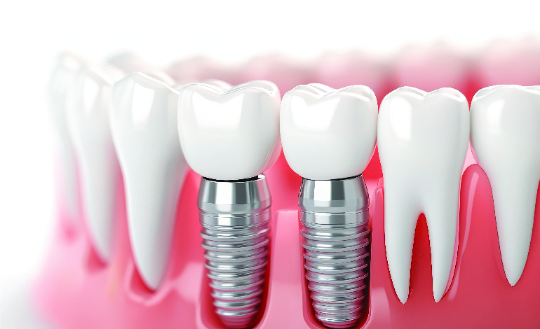 The Role of Attached Gingiva in Implant Therapy