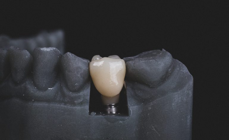 Implant Supported Dental Prostheses and its Maintenance Protocols