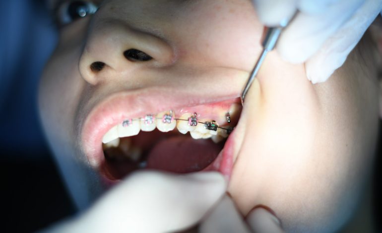 Clear Aligners vs Wire Braces: What Is Best for You?