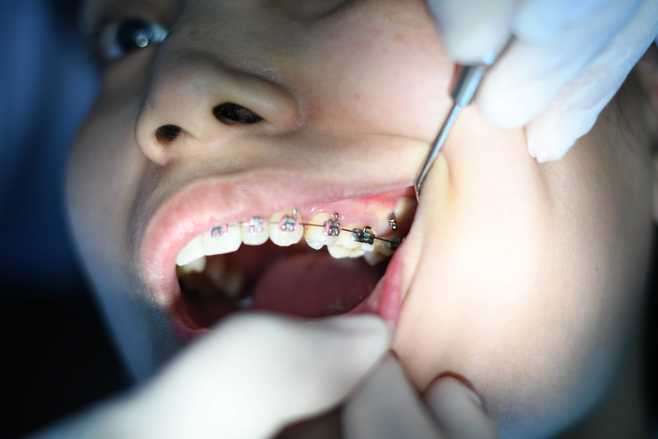 Clear Aligners vs Wire Braces: What Is Best for You?