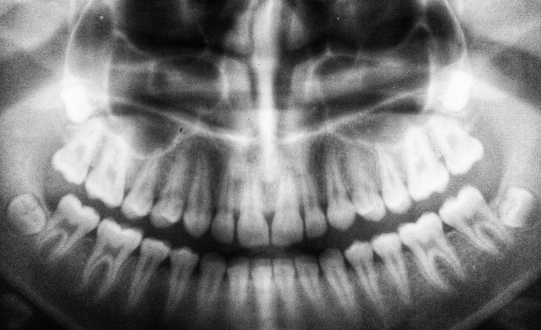 The Importance of Dental X-Rays or Radiographs