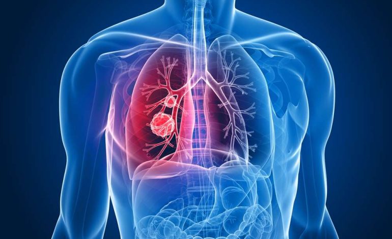 2023 European Cancer Mortality Projections with Emphasis on Lung Cancer