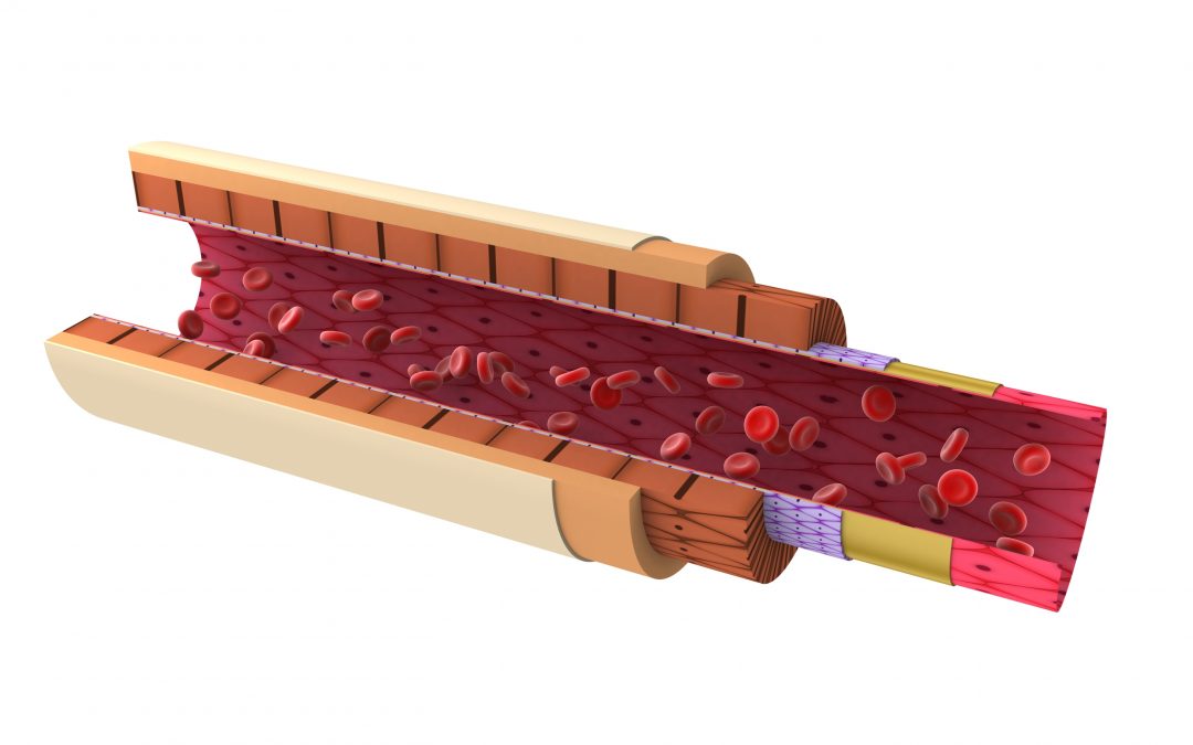 Atherosclerosis disease and treatment