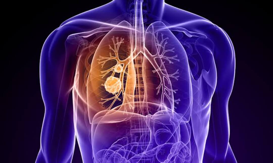 Is there a test to quickly detect early-stage lung cancer?