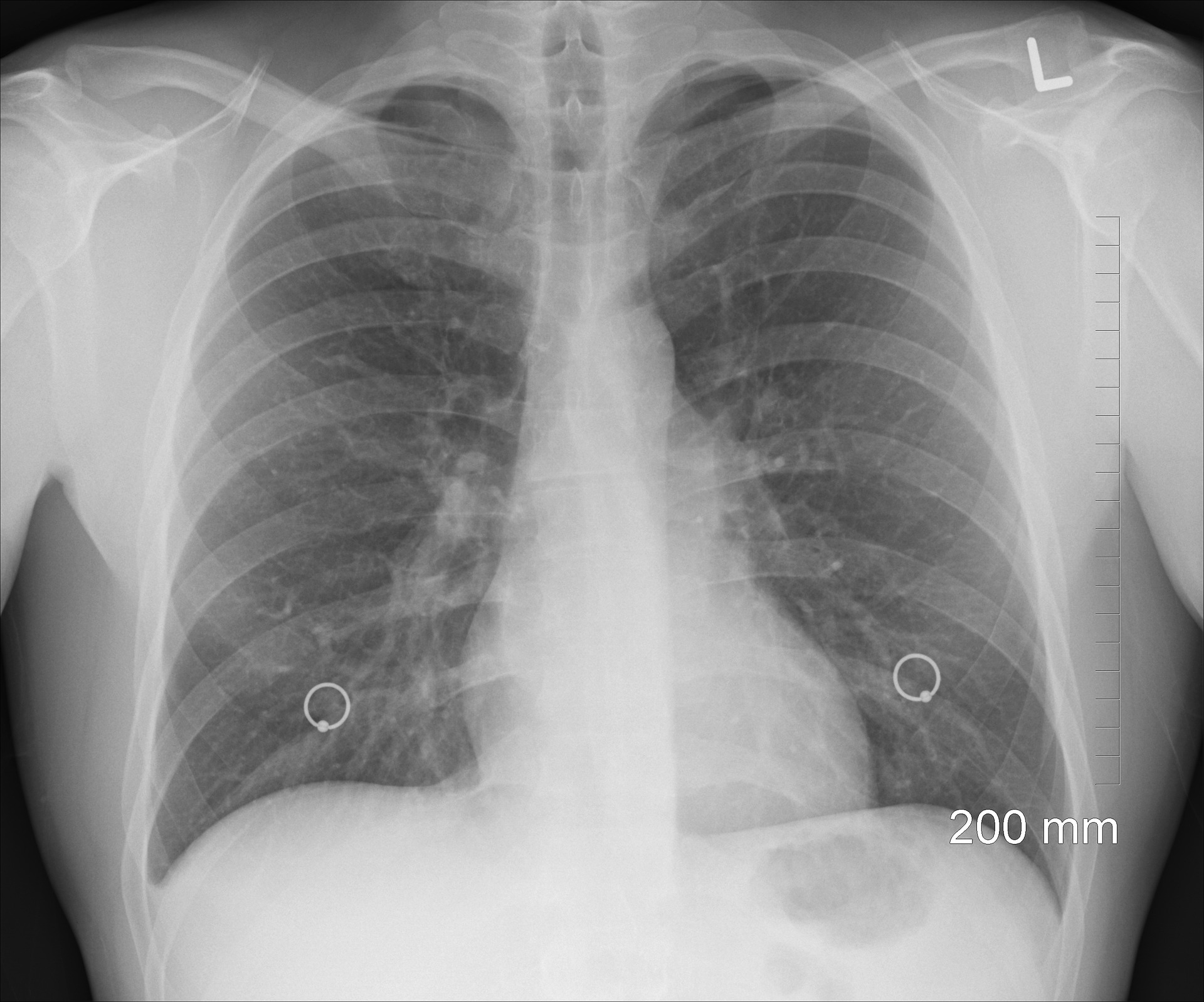 Physiology and consequences of lung hyperinflation in COPD