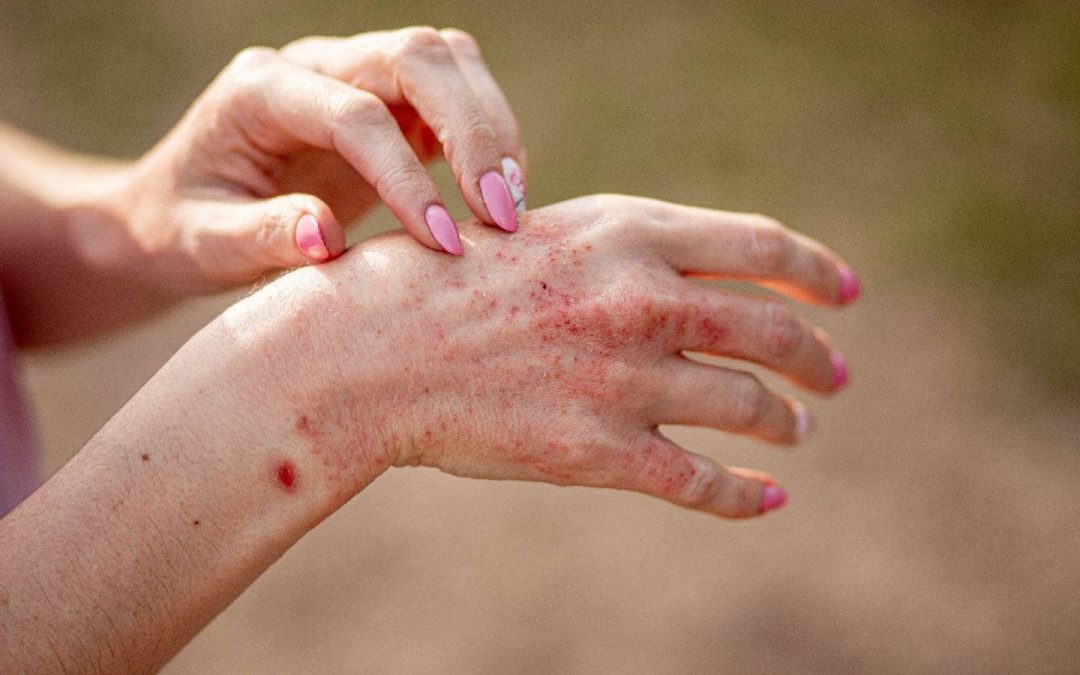 New Treatment for Moderate to Severe Atopic Dermatitis Shows Promising Long-Term Results