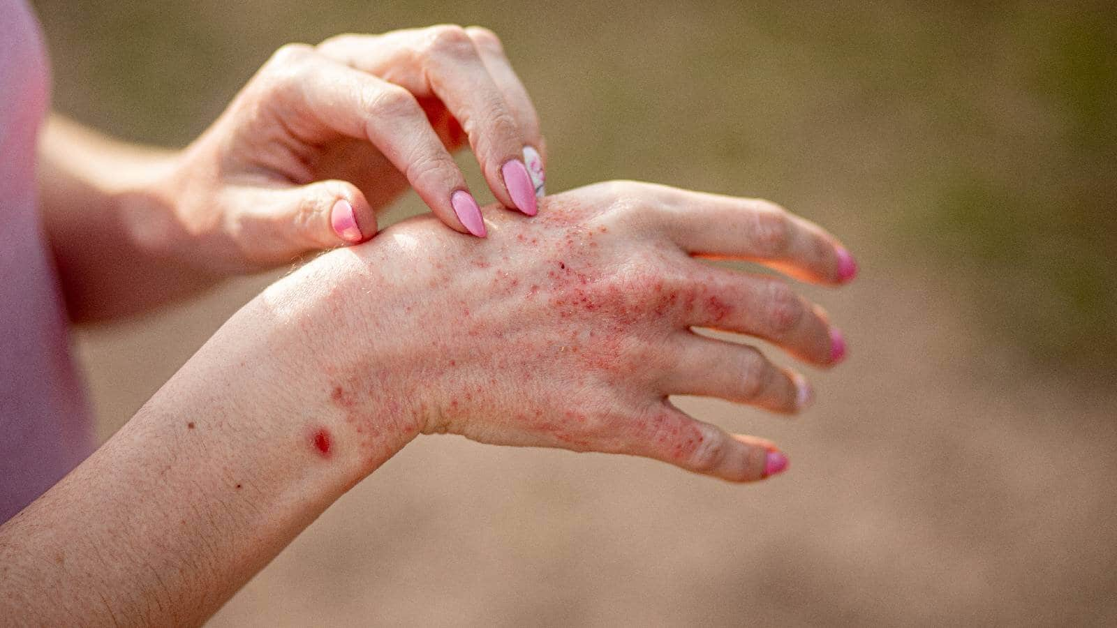 New Treatment for Moderate to Severe Atopic Dermatitis Shows Promising Long-Term Results