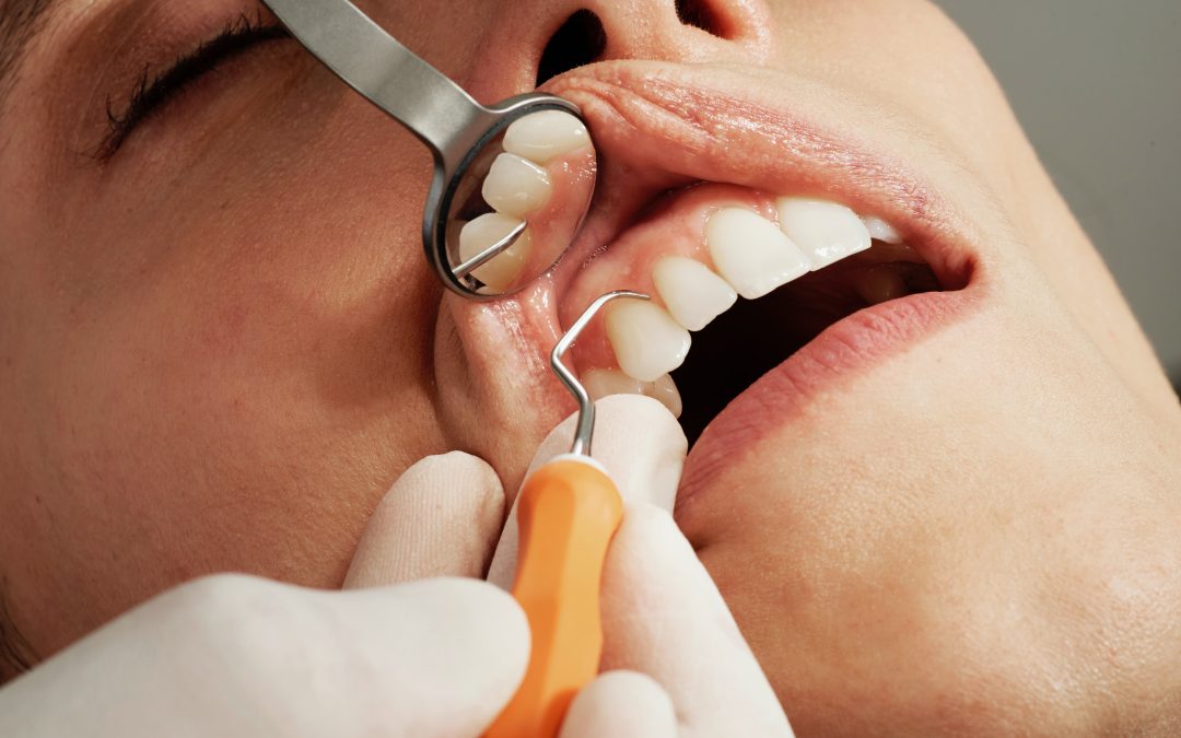 Obesity Raises The Risk Of Gum Disease By Inflating Growth Of Bone-Destroying Cells