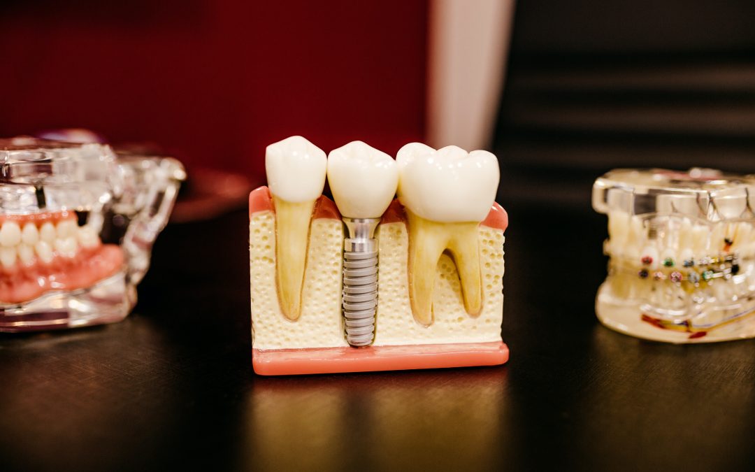 The Advantages of Dental Implants Over Dental Bridges