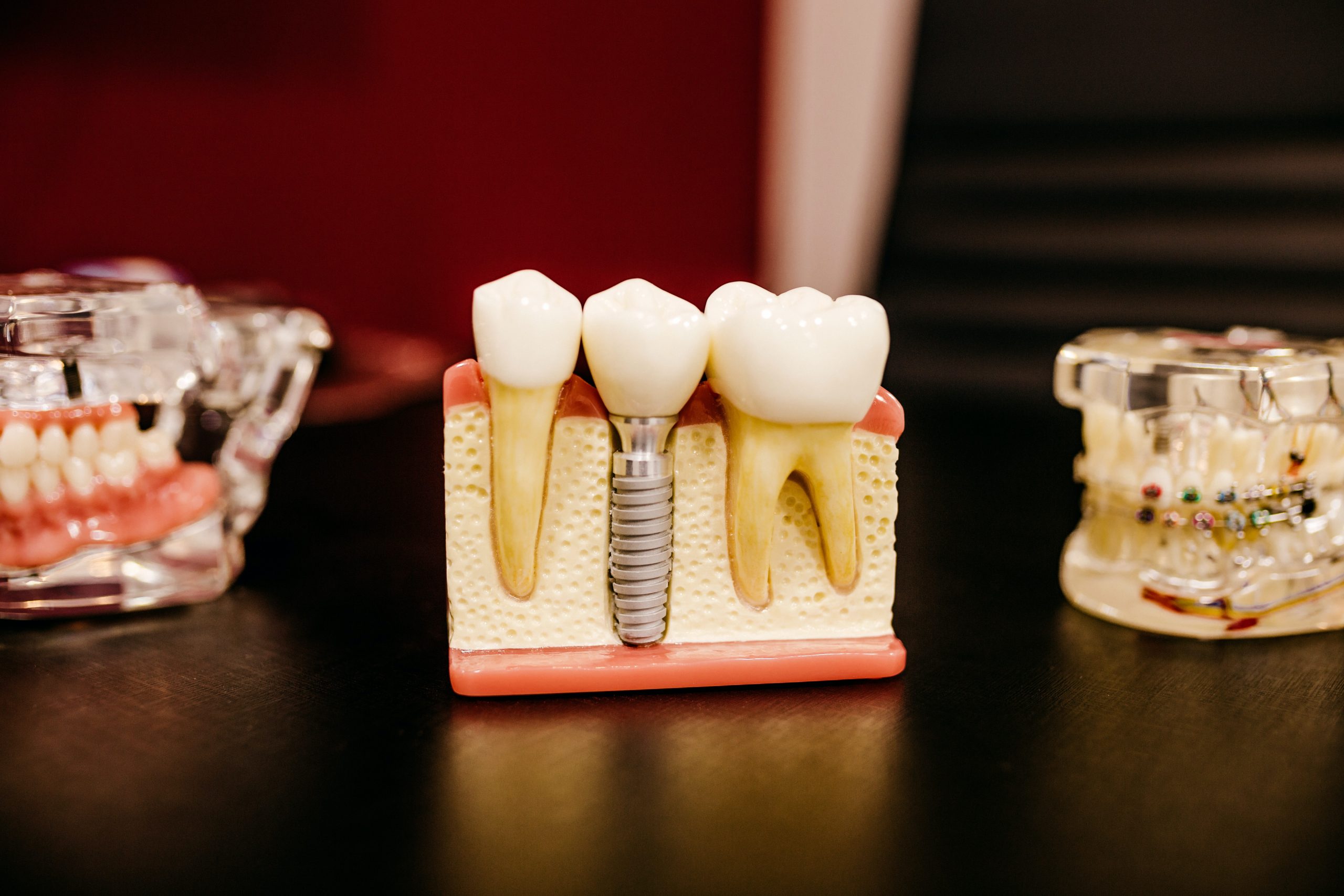 The Advantages of Dental Implants Over Dental Bridges