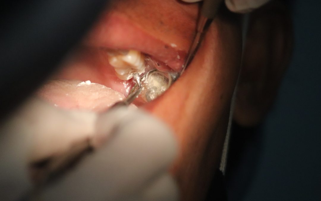 Role of Fluorides in Dentistry
