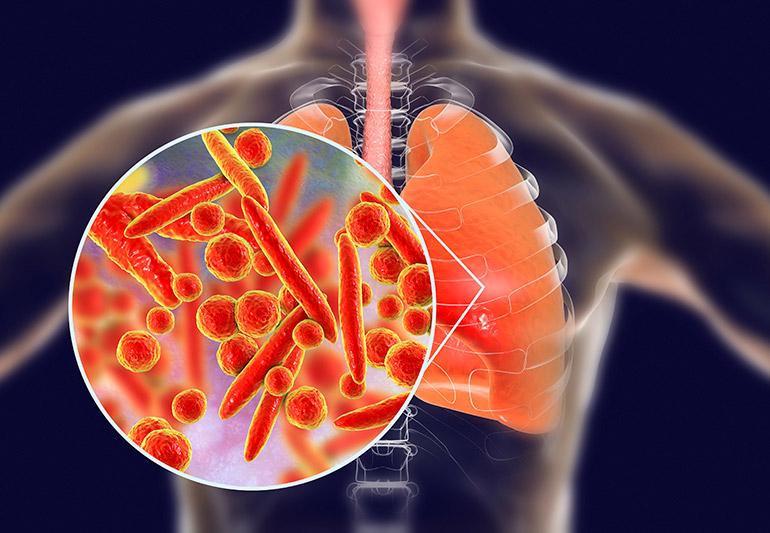 Pneumonia Treatment and Recovery