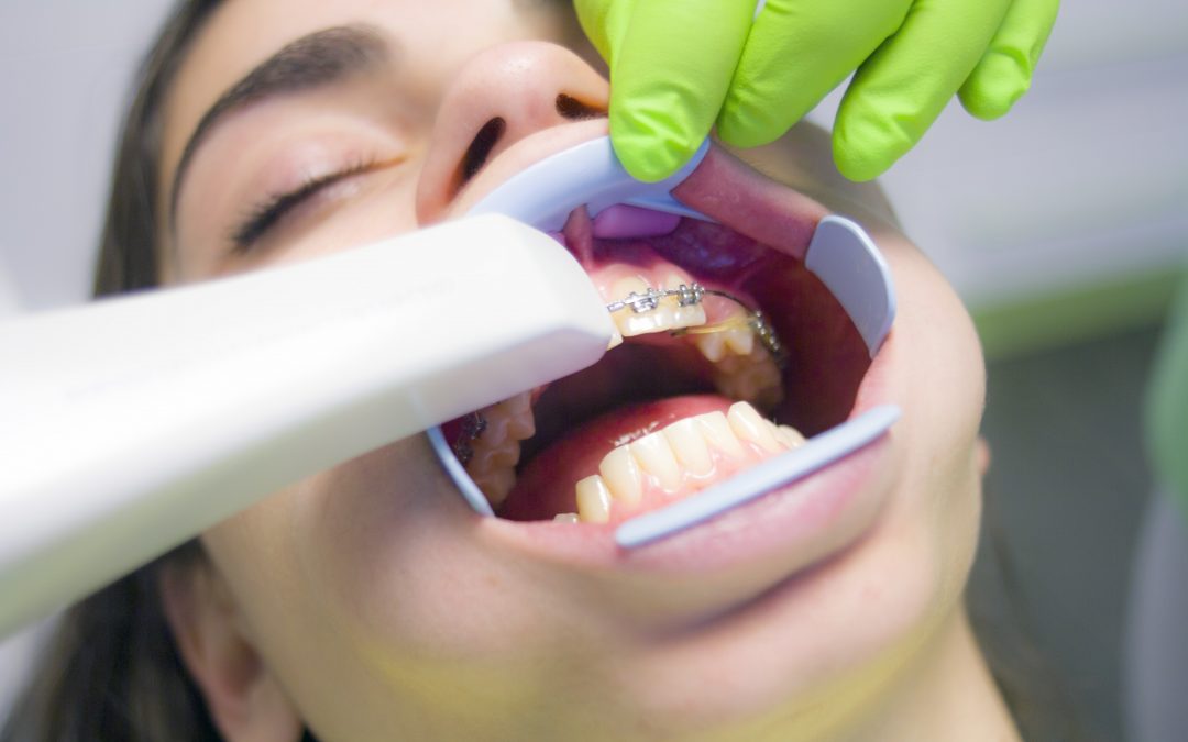 Everything to Know About Dental Bonding