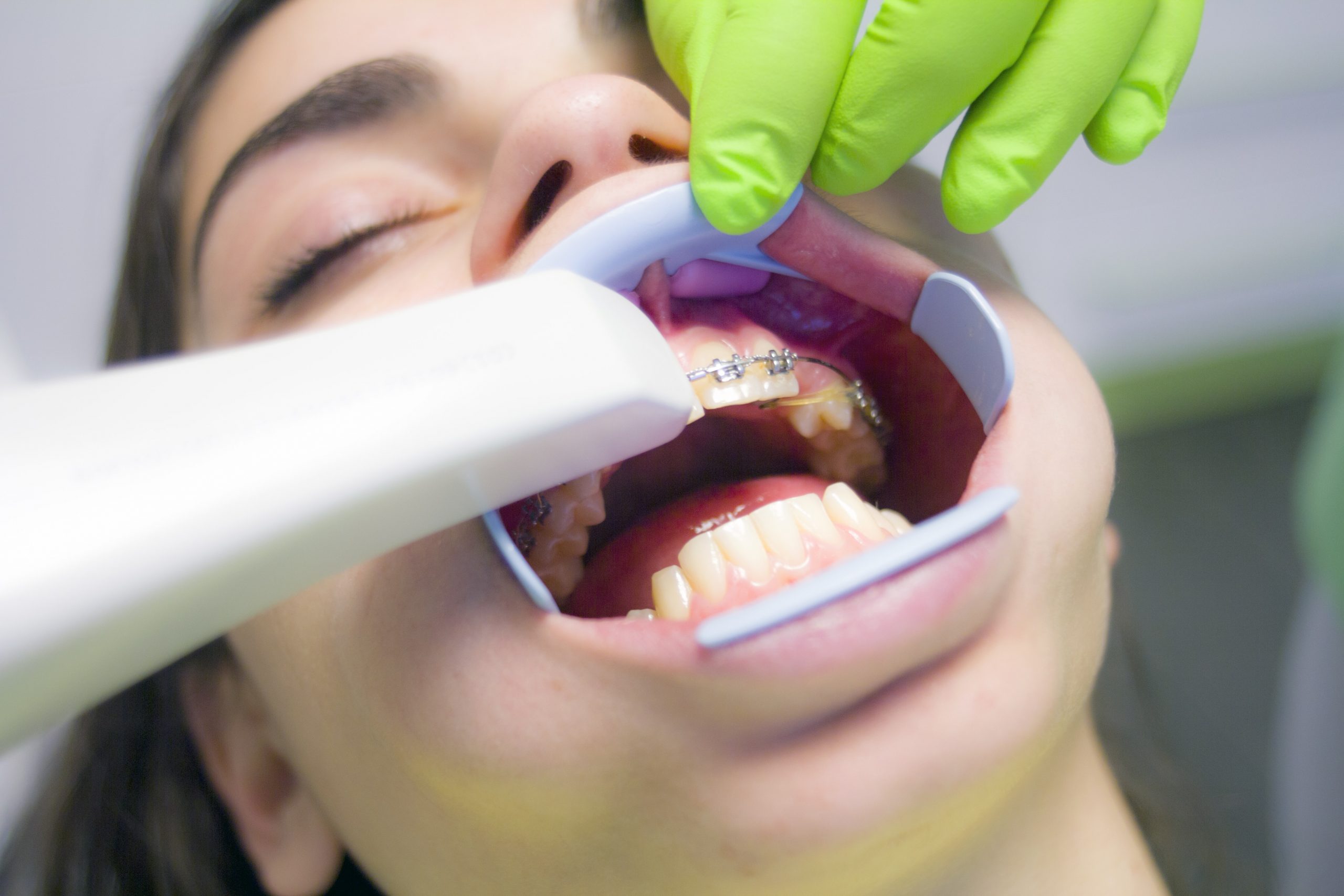 Tooth bleaching procedures and effects