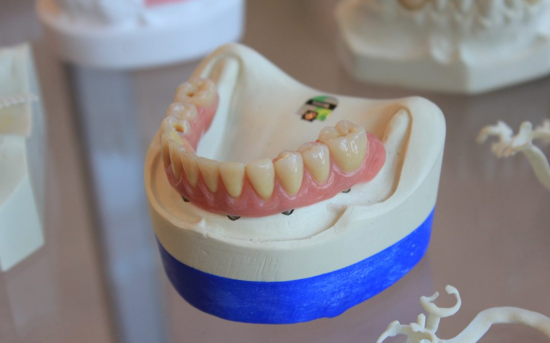 Dental crowns and other extra-coronal restorations
