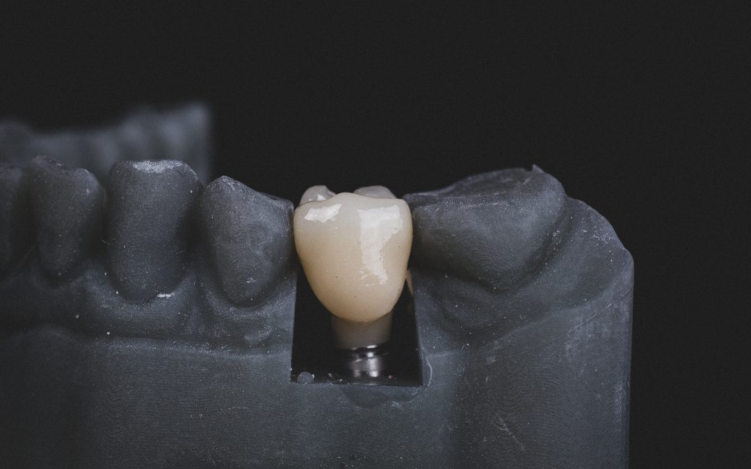 Implant Supported Dental Prostheses and its Maintenance Protocols