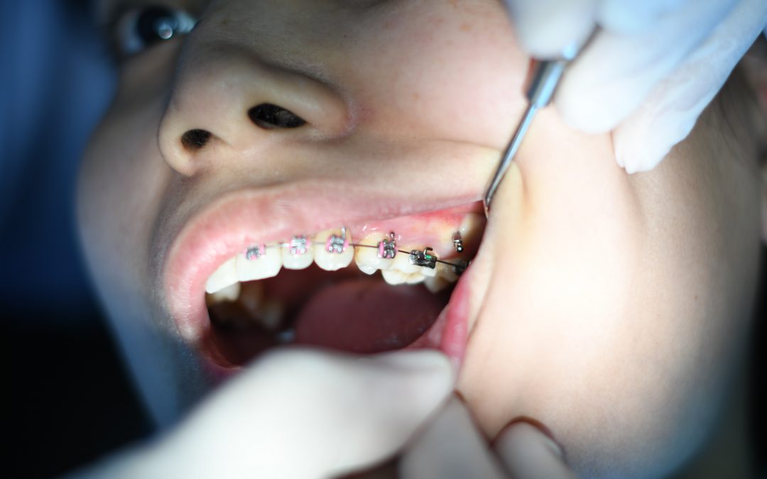 Clear Aligners vs Wire Braces: What Is Best for You?