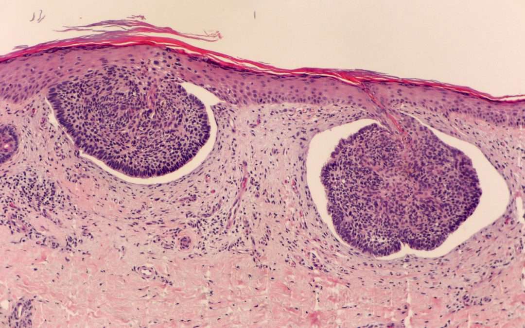 Promising Solutions Unveiled for Effective Management and Treatment of Basal Cell Carcinoma