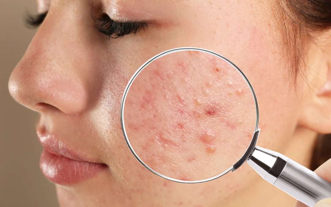 Updates on Acne, Rosacea, and Atopic Dermatitis Treatments