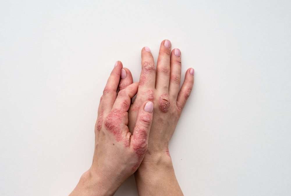 Increased Risk of Cardiovascular Disease in Patients with Inflammatory Skin Diseases