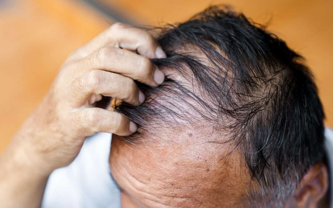Unusual ecchymotic plaques on scalp in his 80s