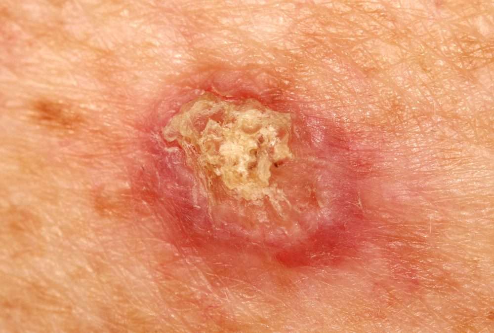 Protecting Your Skin: Expert Tips for Safe Sun Exposure and Skin Cancer Prevention