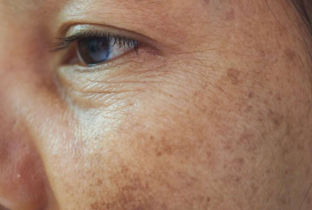 Protecting Your Skin from Sunburn: Important Facts and Prevention Tips